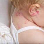 Белые высыпания на предплечье у ребенка: причины, симптомы и лечение