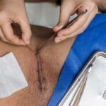 Как удалить швы после лапароскопии - подробная процедура и советы
