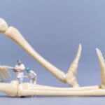 Остеомиелит кости - лечение и профилактика