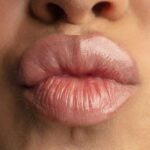 Прыщи на половых губах: причины, лечение, профилактика