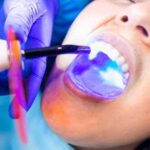 Удаление зубного налета: профессиональное чистка зубов в клинике