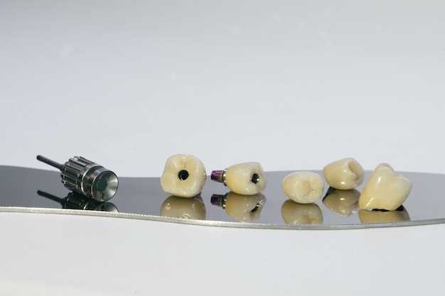 Металлокерамика в услугах стоматологии 'Здоровье'
