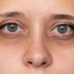 Желтые пятна на веках глаз: причины и методы лечения пигментации