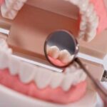 Зубная коронка на имплант: основные этапы установки